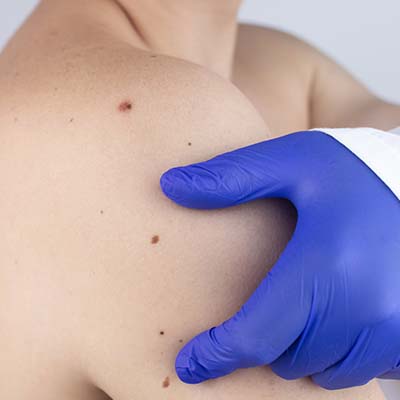 תופעות לואי מחיסונים או מטיפולים כימיים